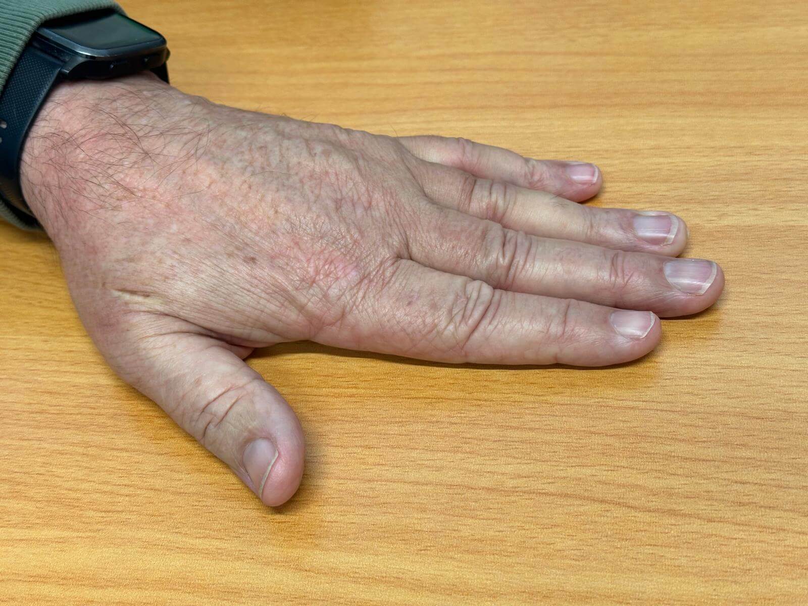 Clive-prior-3-months-post-op-2