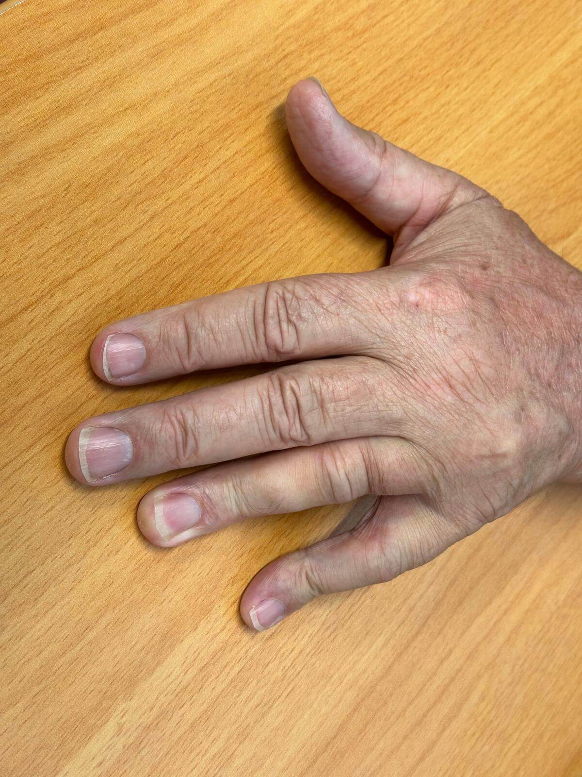 Clive-prior-pre-op-Dupuytrens-3