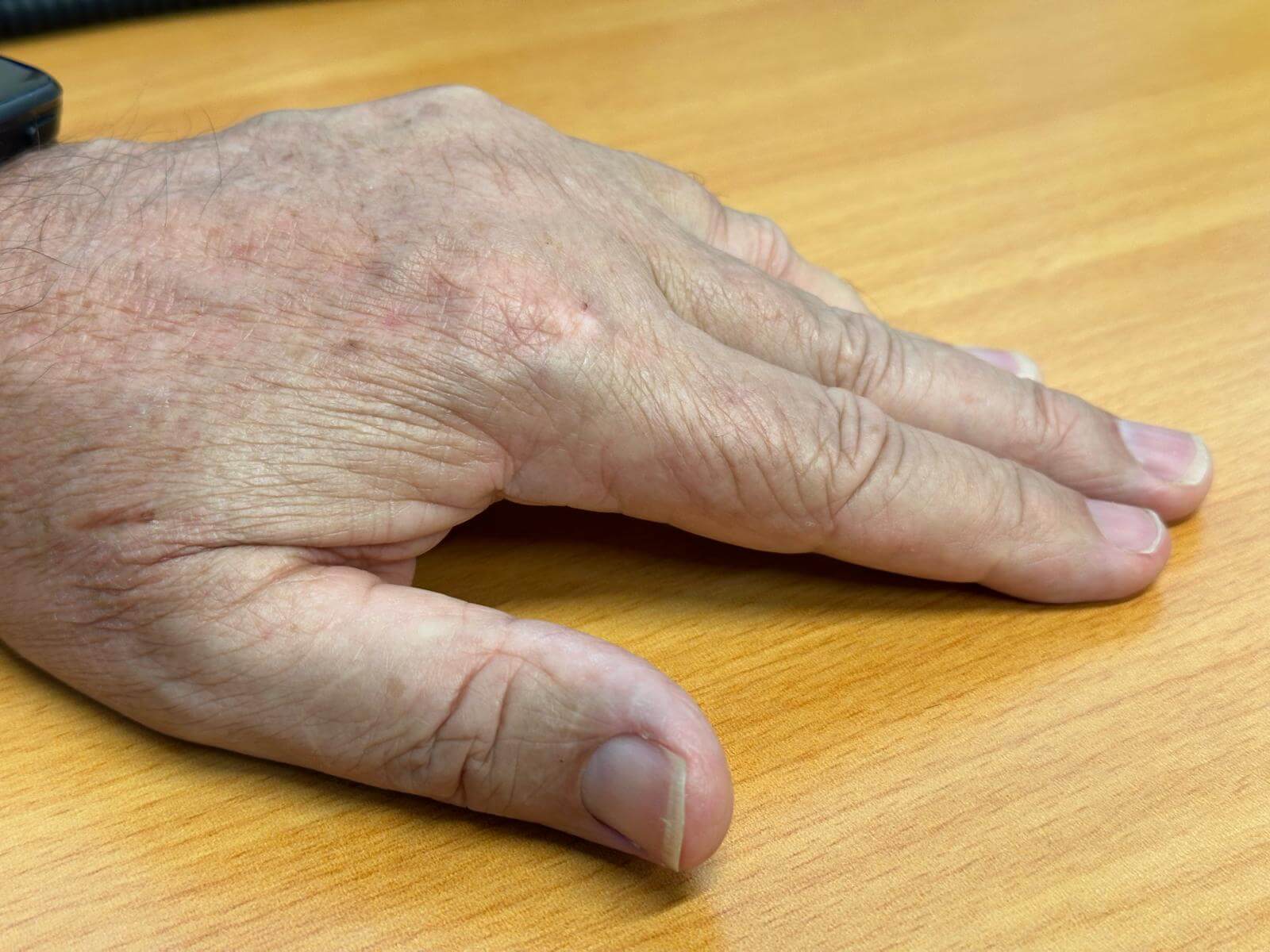 Clive-prior-pre-op-Dupuytrens-4