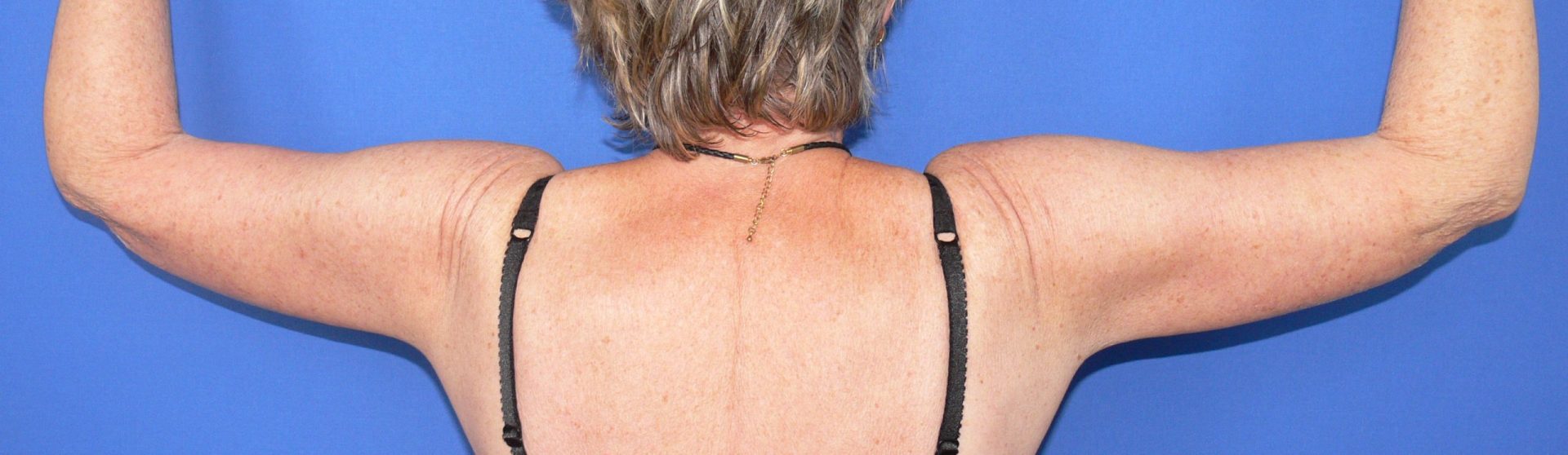 Brachioplasty After