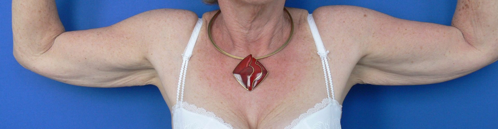 Brachioplasty Before