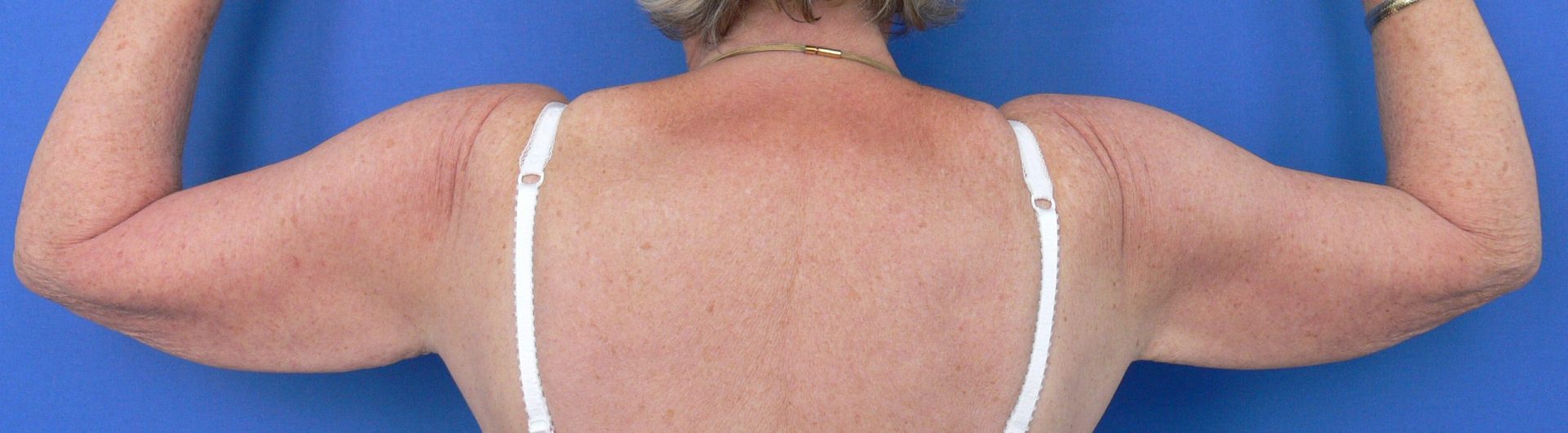 Brachioplasty Before