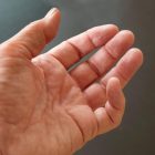 dupuytrens-contracture