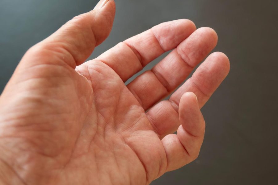 dupuytrens-contracture