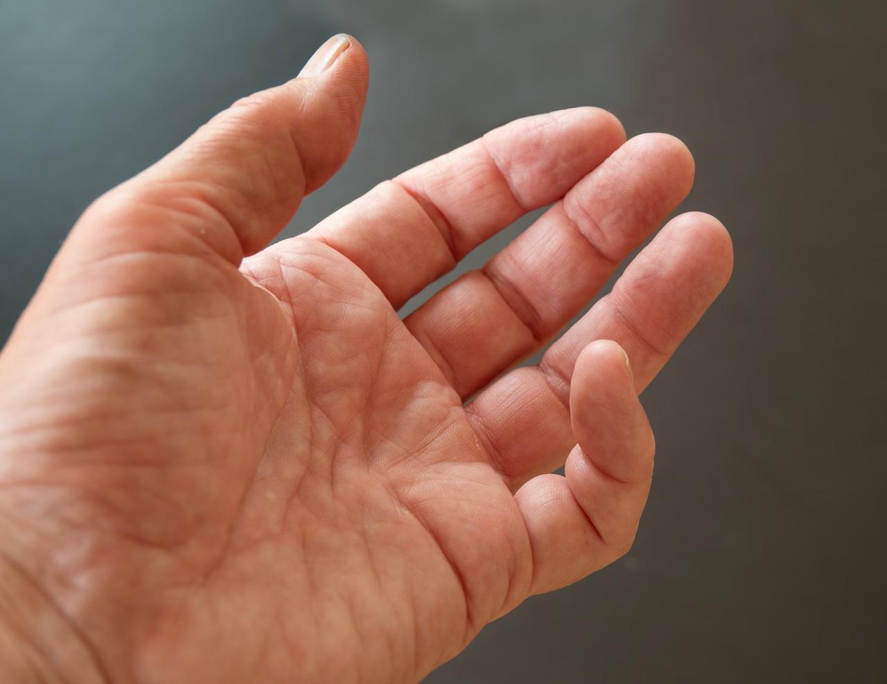 dupuytrens-contracture