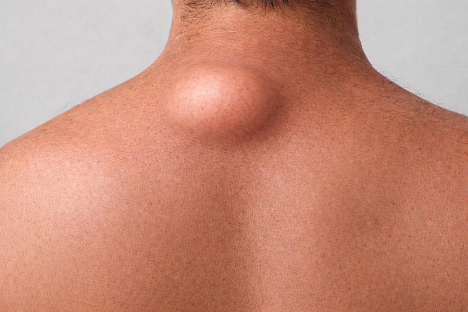 Lumps_under_the_skin_lipoma_ceps_nz