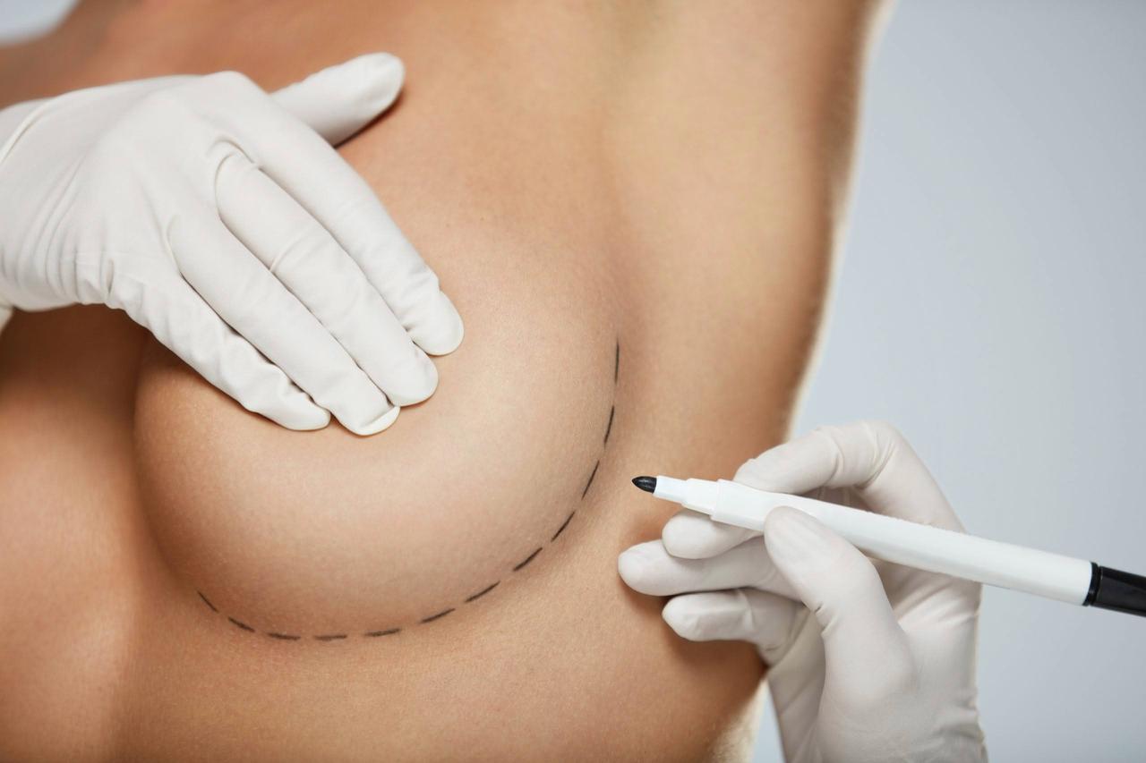 Breast Lift Surgery (Mastopexy): What It Can and Cannot Change